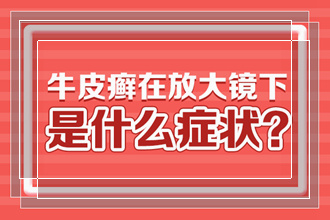 怎样可以让牛皮癣患者进行心理调节帮助恢复病情