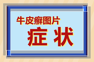 干的牛皮癣出现在身上是什么症状