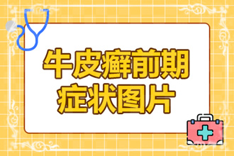 牛皮癣并发症是什么引起的？身体出现4个症状，就是并发症发作的征兆