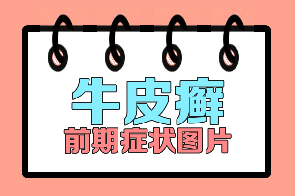 牛皮癣泛发 身有什么危害呢?不要小看牛皮癣!