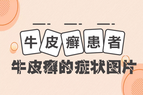 牛皮癣难治易复发,原因究 在哪里?