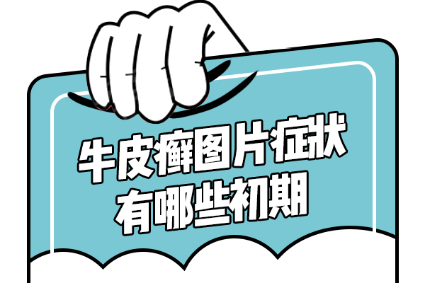 对于牛皮癣你了解多少,治疗牛皮癣时应该注意什么？